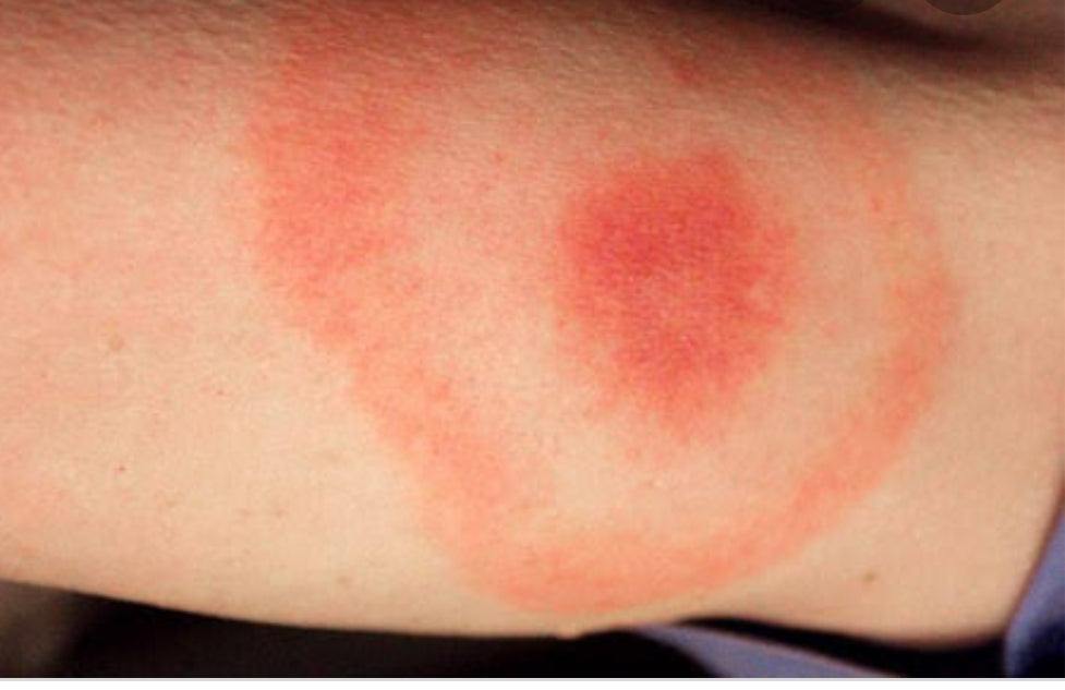 Tick Bite Remedy - 30ml